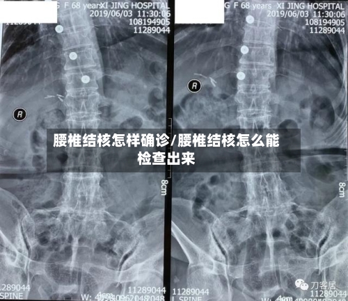 腰椎结核怎样确诊/腰椎结核怎么能检查出来-第2张图片