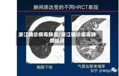 浙江确诊病毒肺炎/浙江确诊病毒肺炎病例