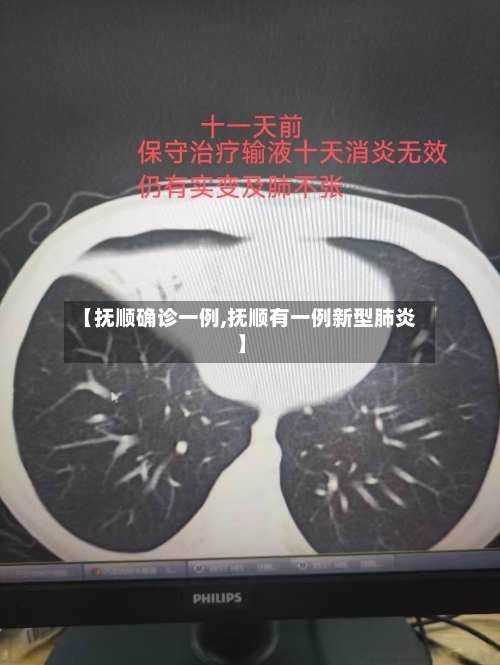 【抚顺确诊一例,抚顺有一例新型肺炎】-第1张图片