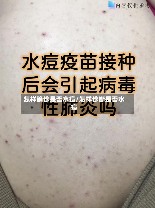 怎样确诊是否水痘/怎样诊断是否水痘