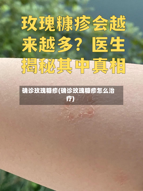确诊玫瑰糠疹(确诊玫瑰糠疹怎么治疗)-第2张图片
